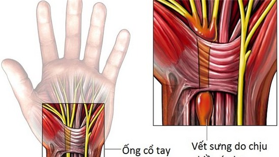 Nghiện đồ công nghệ làm tăng nguy cơ mắc hội chứng ống cổ tay Nghiện đồ công nghệ làm tăng nguy cơ mắc hội chứng ống cổ tay